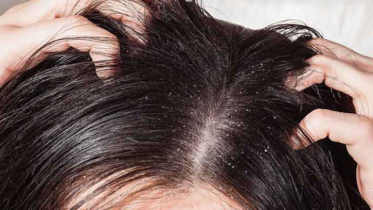 ঘরোয়া ৭ উপায়ে দূর করুন খুশকি, চুলকানি ও চুল পড়া