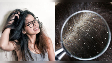 শীতে খুশকি দূর করতে ৪টি ঘরোয়া কৌশল