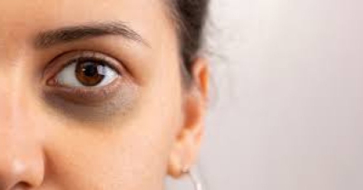 দুশ্চিন্তার কারণ যখন ডার্ক সার্কেল