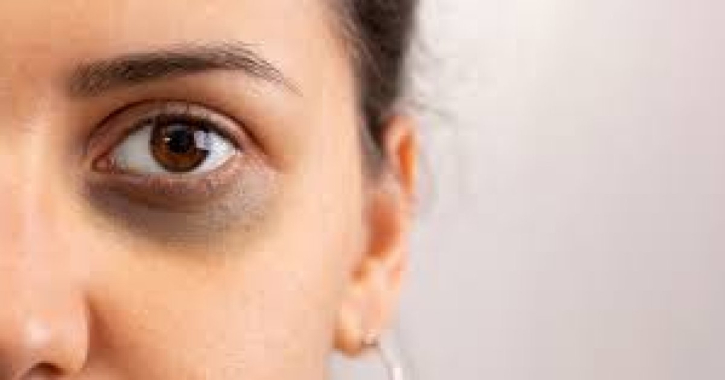 দুশ্চিন্তার কারণ যখন ডার্ক সার্কেল