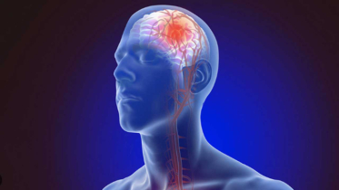 বিশ্ব স্ট্রোক দিবস: সচেতনতা, প্রতিরোধ ও দ্রুত চিকিৎসার আহ্বান বিশ্ব স্ট্রোক দিবস: সচেতনতা, প্রতিরোধ ও দ্রুত চিকিৎসার আহ্বান